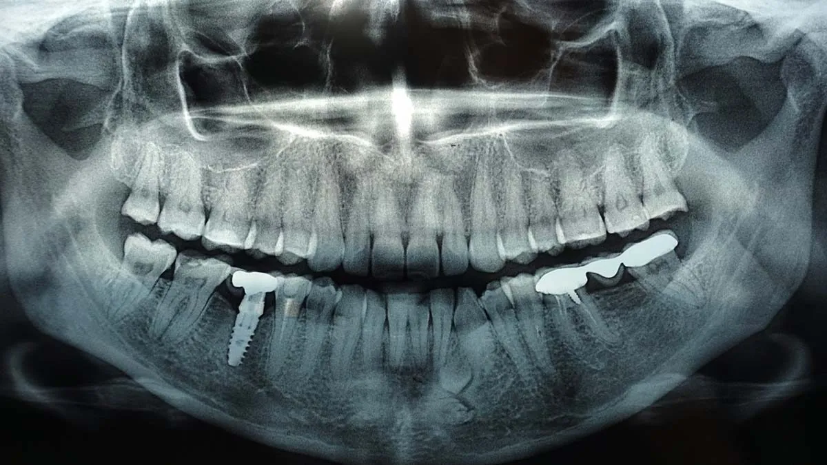 Are Frequent Dental X-Rays Risky? Experts Weigh In on Radiation and Your Health