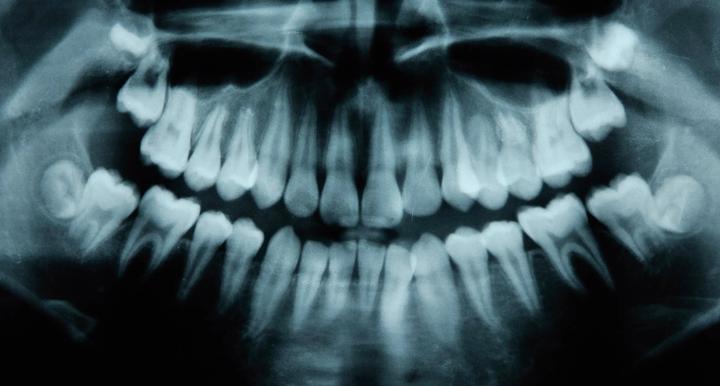 Are Frequent Dental X-Rays Risky? Experts Weigh In on Radiation and Your Health